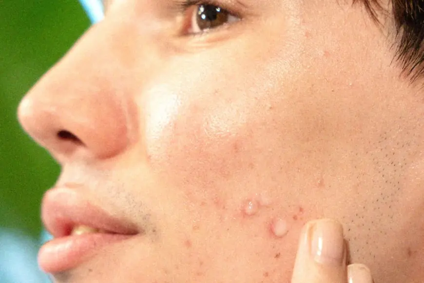 Which Acne Scar Treatments Work Fastest For Clear Skin?