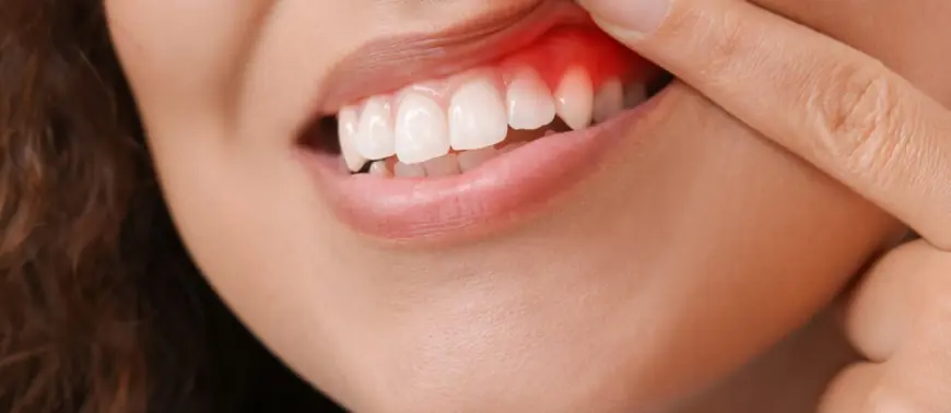 How Gum Contouring Boosts Confidence in Your Smile
