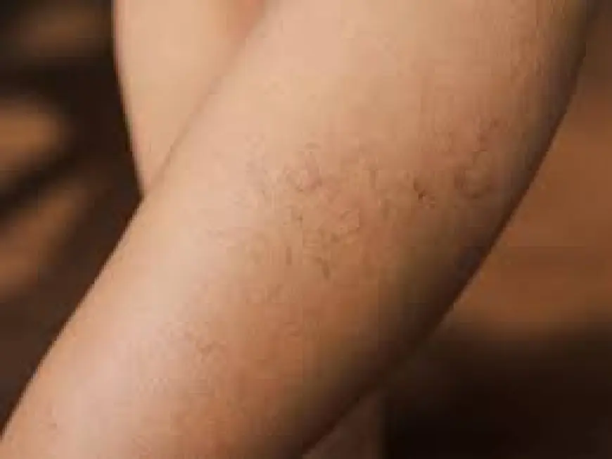 Understanding Options for Vein Treatment in San Antonio