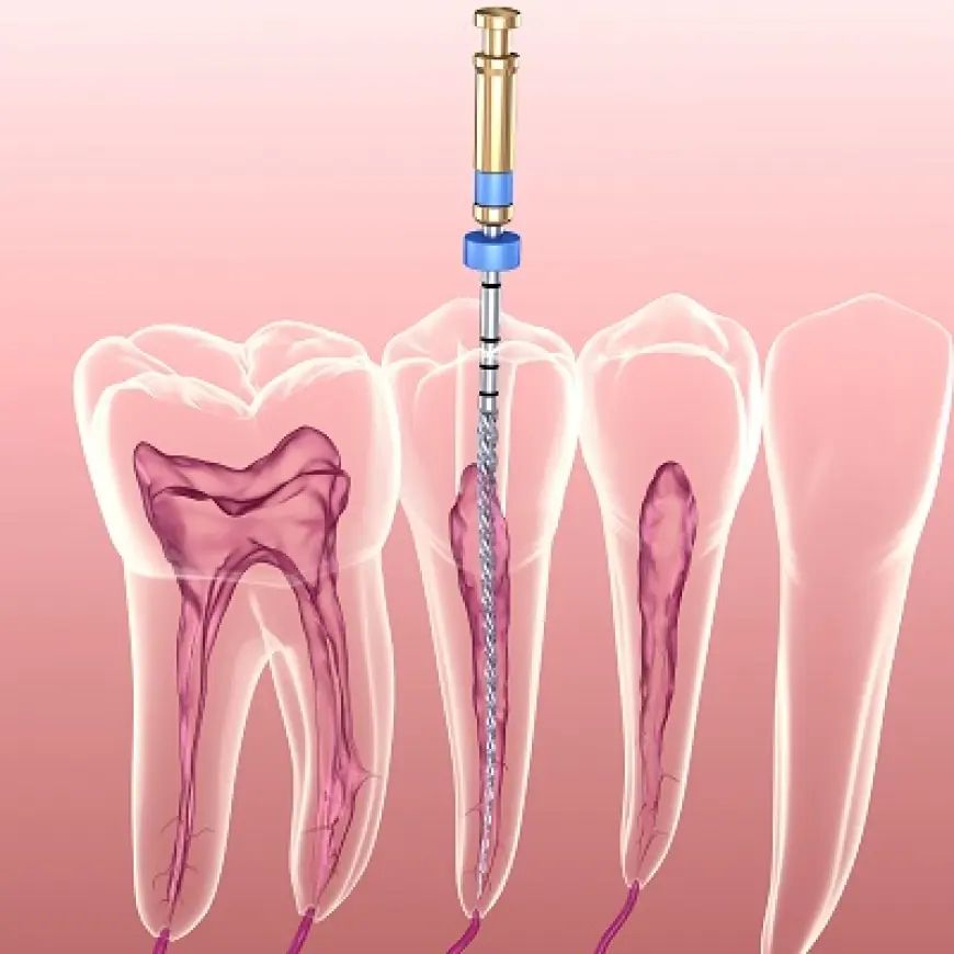 Root Canal Specialists in Islamabad – Advanced & Affordable Care
