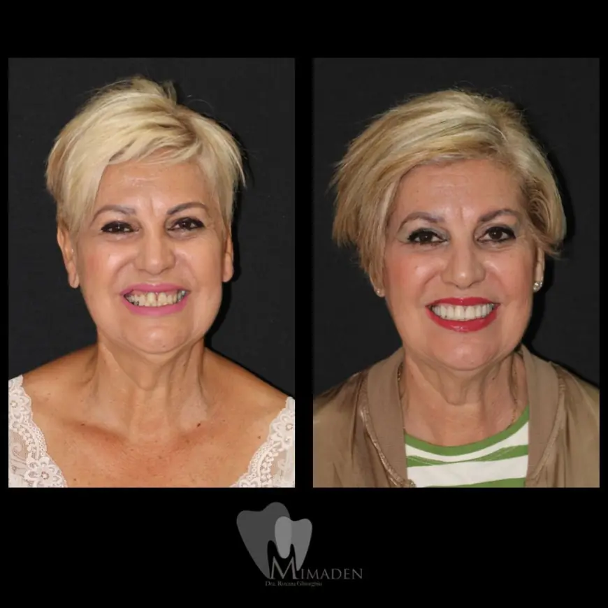 Blanqueamiento Dental en Hospitalet de Llobregat Dientes Más Blancos y Brillantes