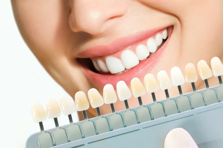 Composite Veneers in Dubai: Everything You Should Know