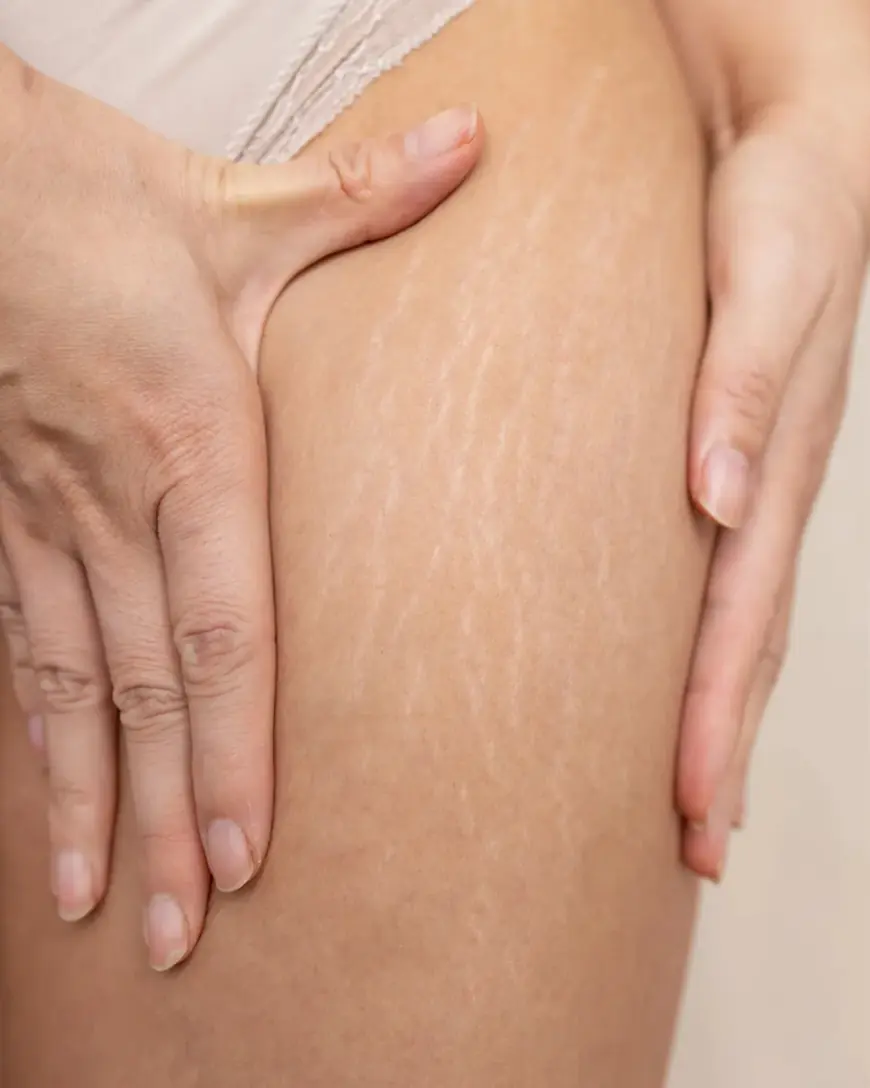 Can Men Also Benefit from Stretch Marks Removal Treatments?
