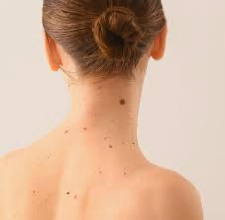 Does Mole Removal Leave a Scar?