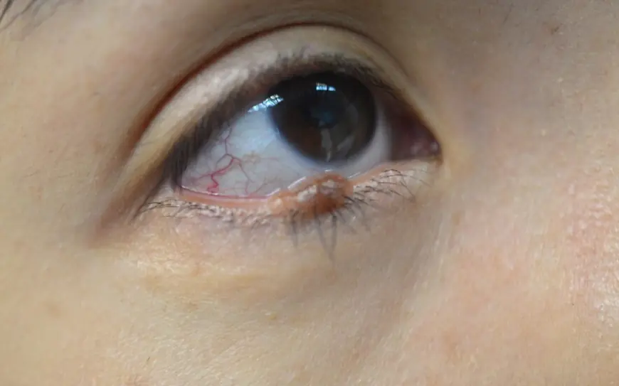 Can Mole Removal Be Done on Eyelids?