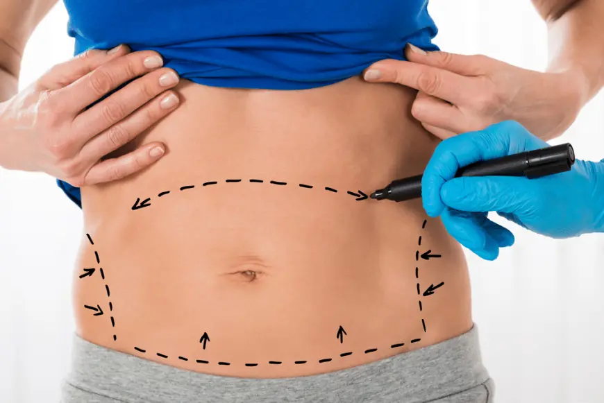 What Is a Tummy Tuck and How Does the Surgery Work?