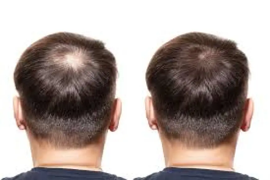 Dubai’s Top Hair Transplant Experts in the UAE
