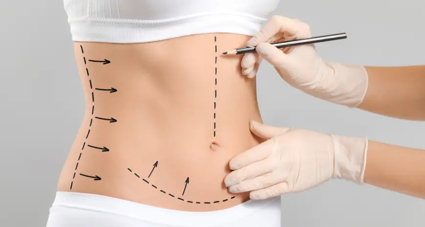 Liposuction Cost in Islamabad – Complete Guide
