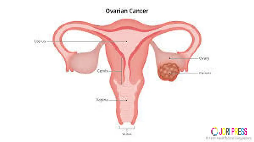 Ovarian Cancer Treatment Cost in India – A Complete Guide to Affordable Care