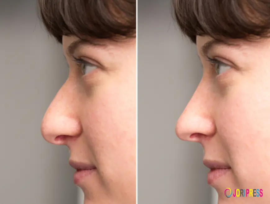 Expert Guide to Revision Rhinoplasty Procedures in Riyadh