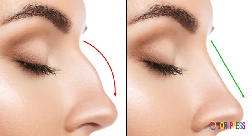 Revision Rhinoplasty in Riyadh: Correcting Past Surgeries