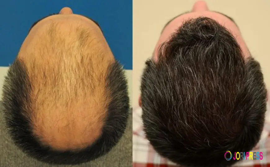 Natural Ways to Support Hair Growth After a Hair Transplant in Islamabad