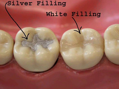 High-Quality Dental Tooth Fillings in Islamabad – Book Now