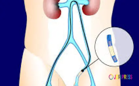 Step-by-Step Varicocele Embolization Recovery Aftercare