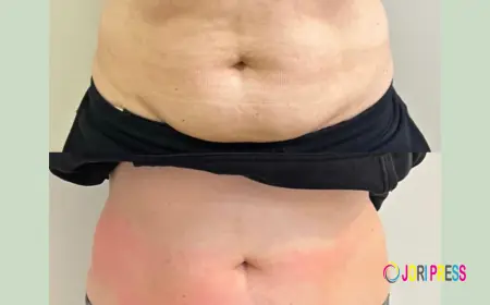 Tummy Tuck in Islamabad: Get a Smooth and Contoured Abdomen