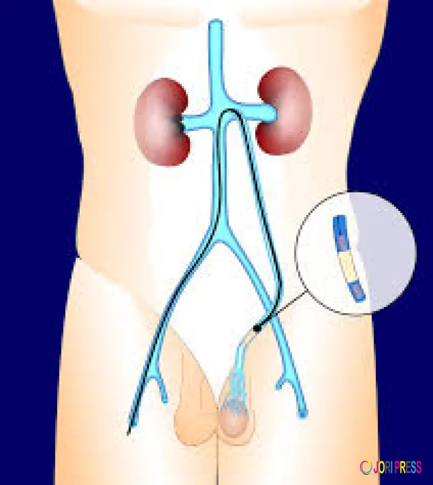 Step-by-Step Varicocele Embolization Recovery Aftercare