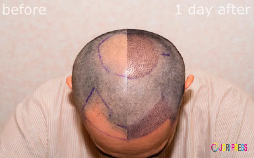 Hair Transplant UK: Want Hair Ltd Helps Transform Thinning Hair into Full, Healthy Locks