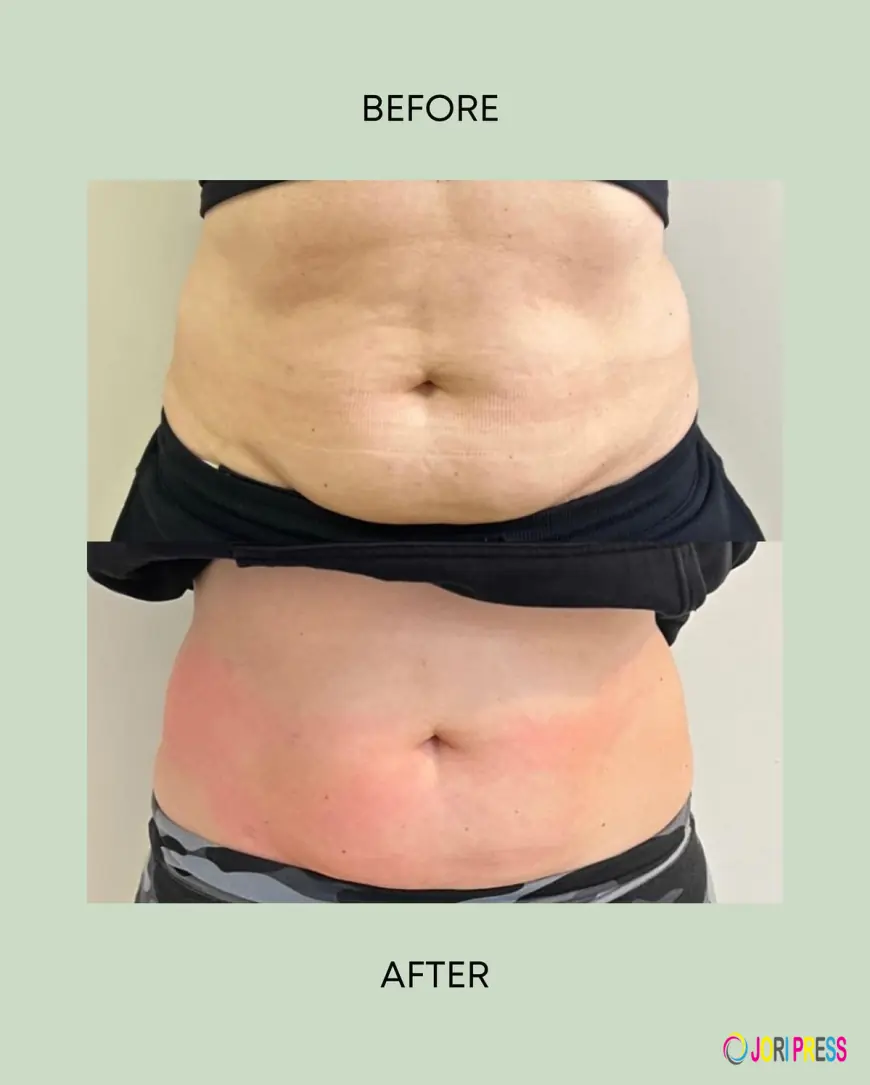 Tummy Tuck in Islamabad: Get a Smooth and Contoured Abdomen