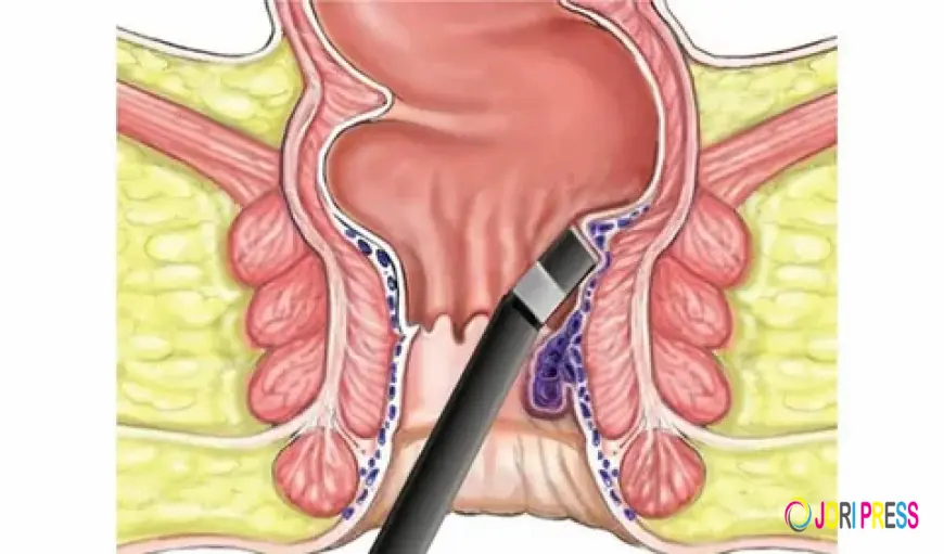 Struggling with Painful Bowel Movements? Here’s How Expert Fissure Doctors in Coimbatore Can Help