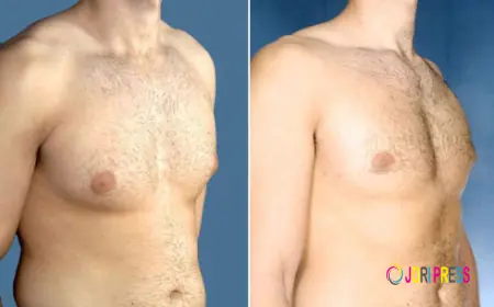 Avoid These Mistakes When Trying to Reduce Gynecomastia Naturally