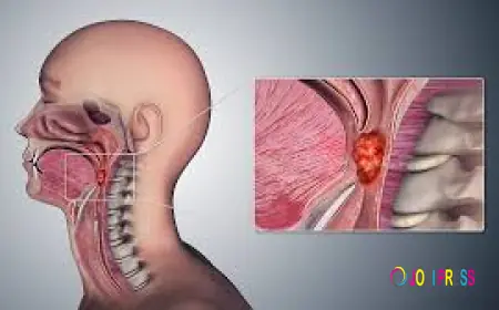 Throat Cancer Treatment in India – Diagnosis, Cost, and Success Rate