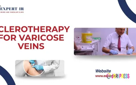 Sclerotherapy for Varicose Veins: An Effective Minimally Invasive Treatment in Pune