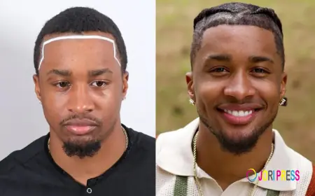 Afro Hair Transplant: The Complete Guide for Natural, Curly Hair Restoration