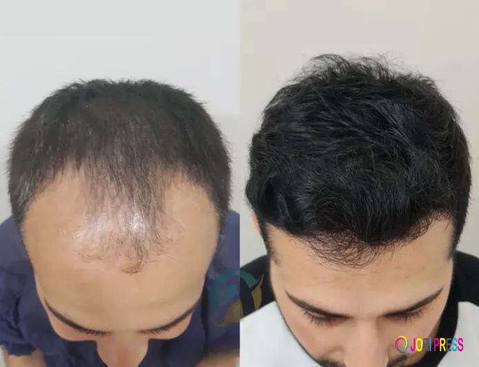 PRP Hair Regrowth in Islamabad: Natural and Safe Solution
