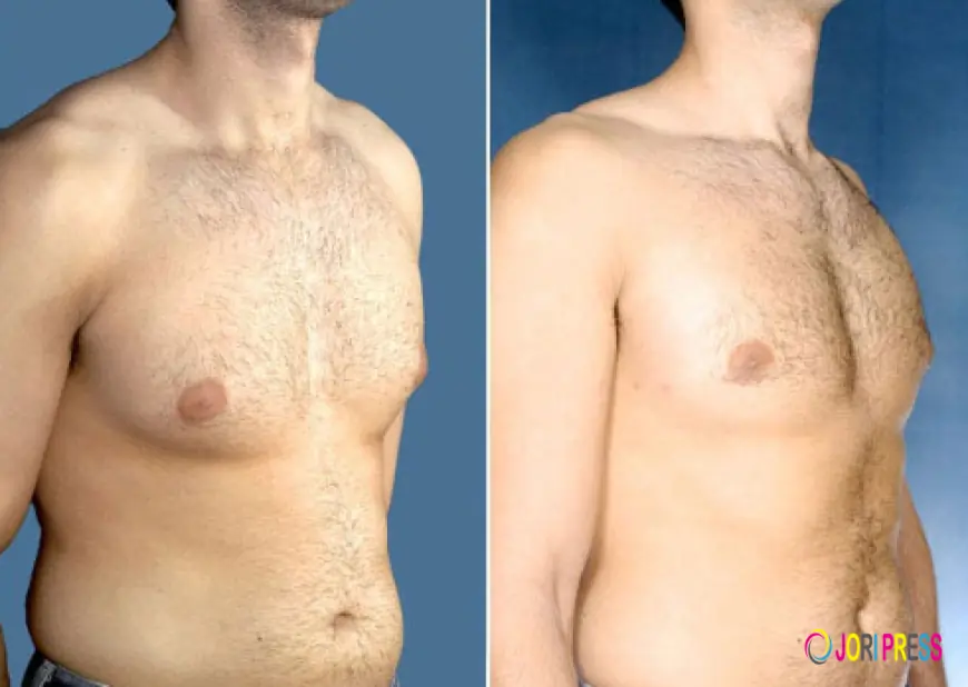 Avoid These Mistakes When Trying to Reduce Gynecomastia Naturally