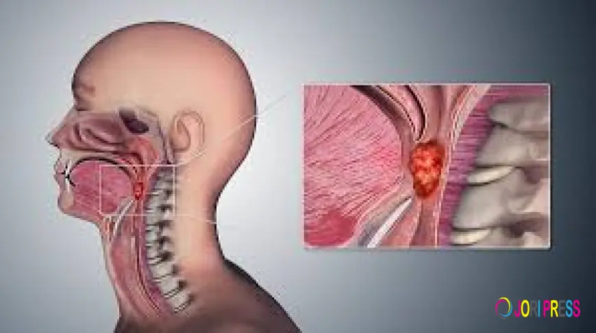 Throat Cancer Treatment in India – Diagnosis, Cost, and Success Rate