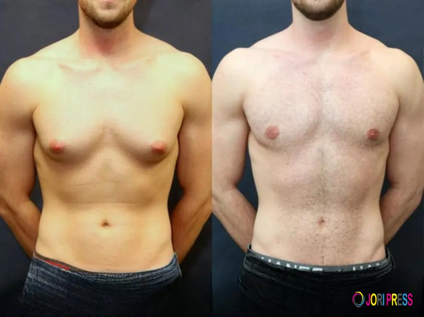 Boost Your Confidence with Gynecomastia Surgery in Islamabad