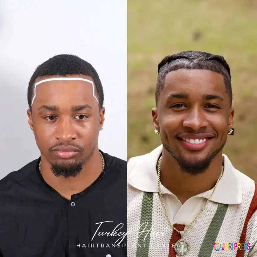 Afro Hair Transplant: The Complete Guide for Natural, Curly Hair Restoration