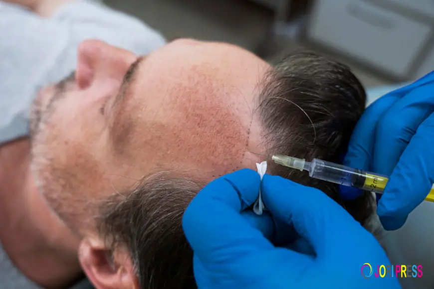 Want Hair Ltd Reveals Breakthrough Treatment Options for Hair Loss in London