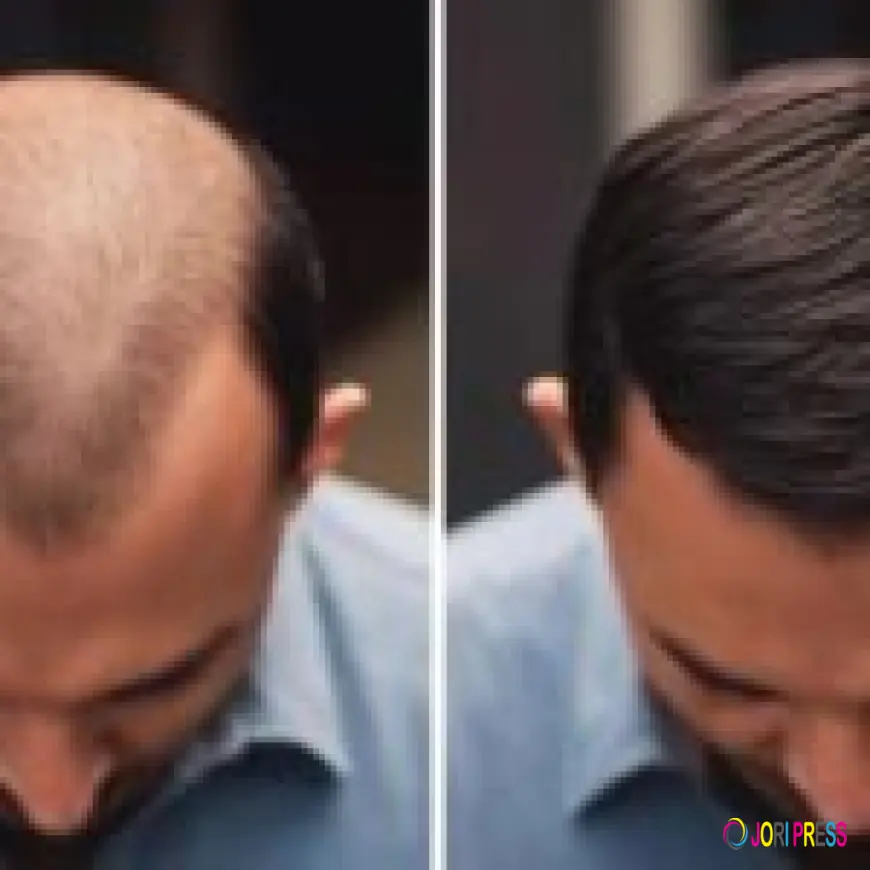 Say Goodbye to Flakes: Best Anti-Dandruff Treatment in Calicut, Kerala