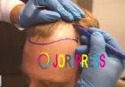 FUE Hair Transplant Istanbul, Turkey: Want Hair Ltd Showcases Natural-Looking Results
