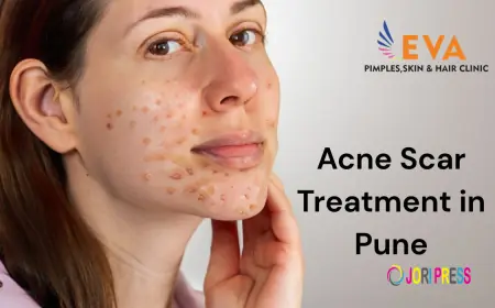 Best Acne Scar Treatment in Pune – Advanced Solutions at EVA Skin Clinic