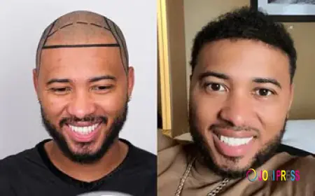 Hair loss affects Advatage Turkey hair transplant