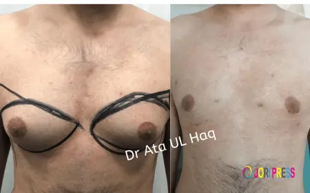 Does Gynecomastia Surgery Hurt?