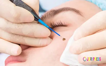 Mole Removal in Dubai: Safe Solutions for Clear, Smooth Skin