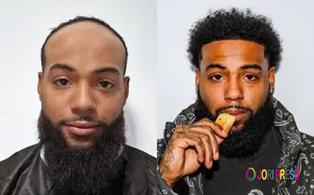 Why Afro Hair Transplant Requires Specialized Expertise