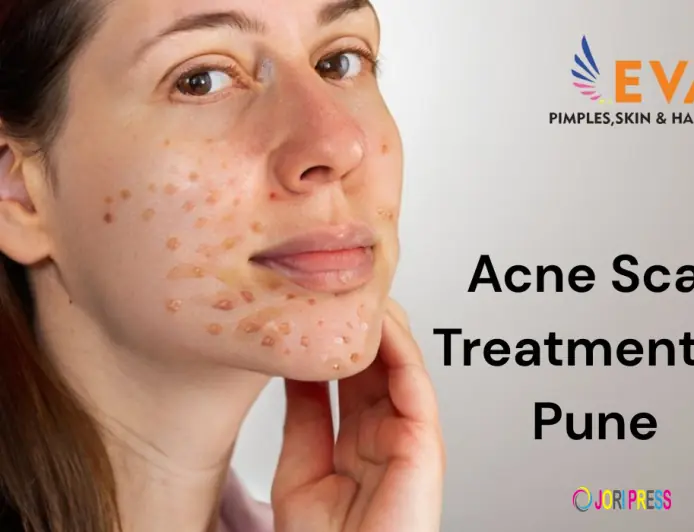 Best Acne Scar Treatment in Pune – Advanced Solutions at EVA Skin Clinic