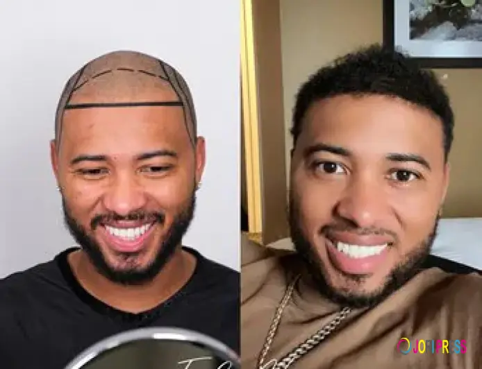 Hair loss affects Advatage Turkey hair transplant