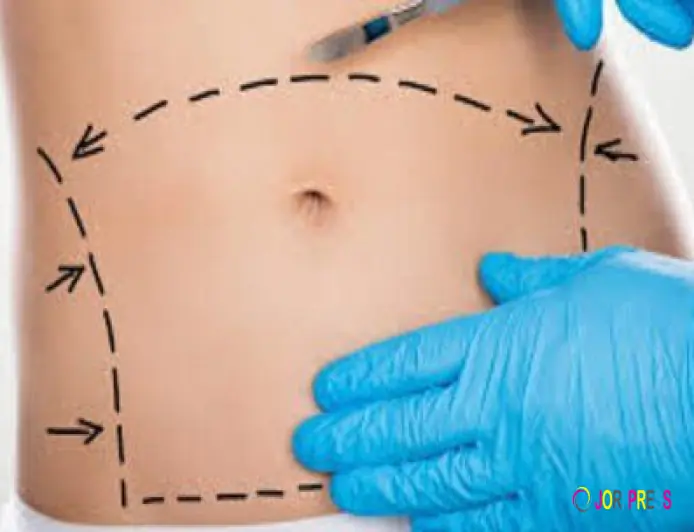 Can Tummy Tuck Surgery Improve Abdominal Muscle Tone?