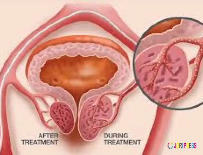 Modern Solutions for Enlarged Prostate Treatment