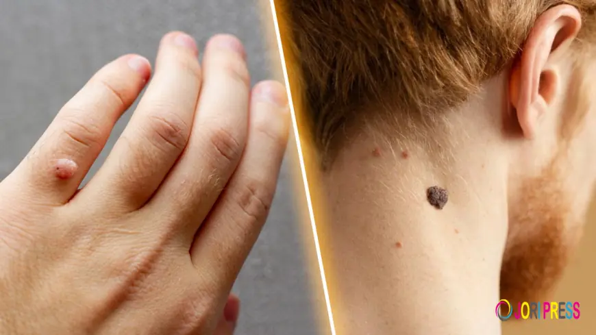 Are Skin Tags Contagious? A Complete Beginner’s Guide