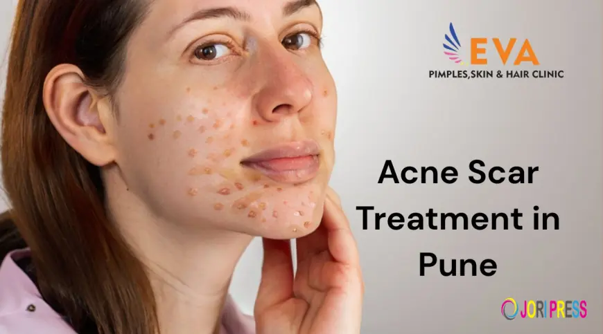 Best Acne Scar Treatment in Pune – Advanced Solutions at EVA Skin Clinic