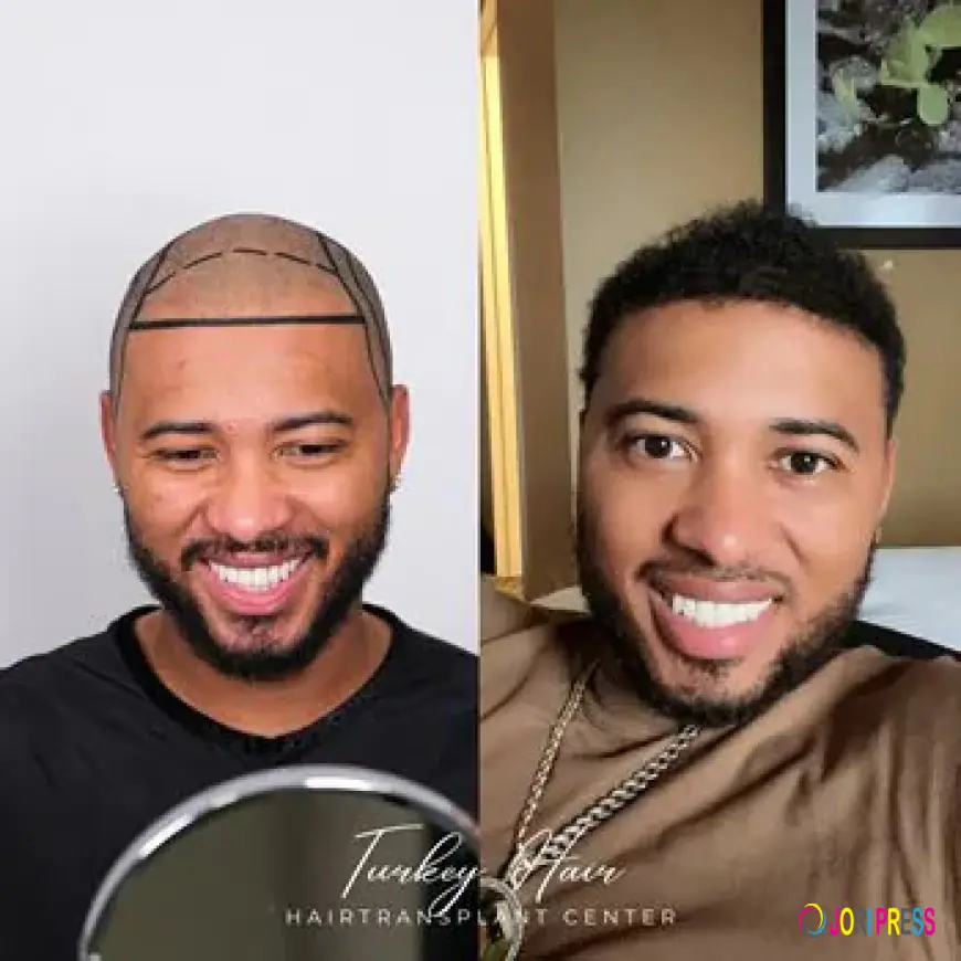 Hair loss affects Advatage Turkey hair transplant