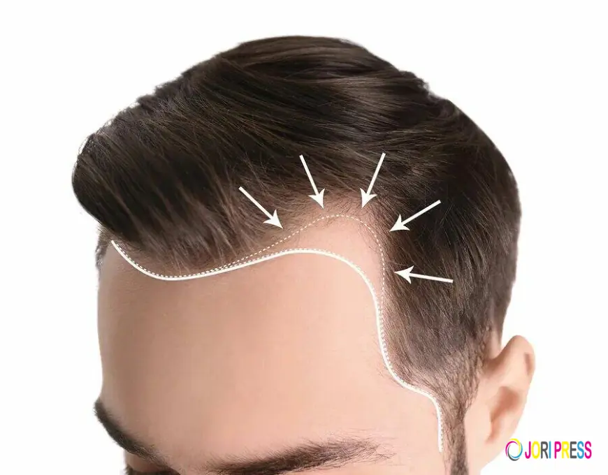Hair Transplant in Sharjah: Long-Lasting Results