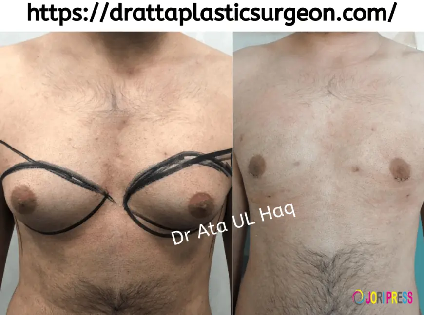 Does Gynecomastia Surgery Hurt?