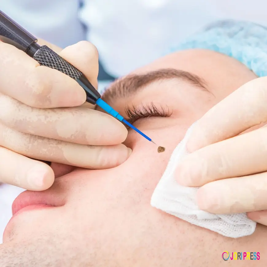 Mole Removal in Dubai: Safe Solutions for Clear, Smooth Skin